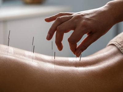 Акупунктура